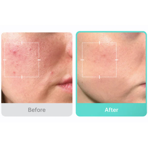 Medicube Azelaic Acid 16% Calming Serum – 30ml 2